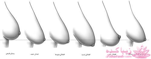 روشهای جلوگیری ازافتادگی سینه ها در زنان